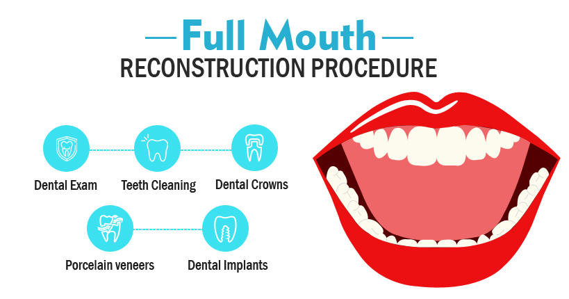 Full Mouth Reconstruction Procedure