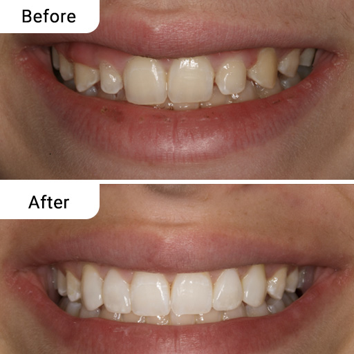 Before and After Dental Treatment