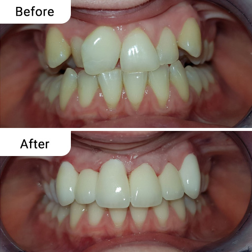 Before and After Dental Treatment