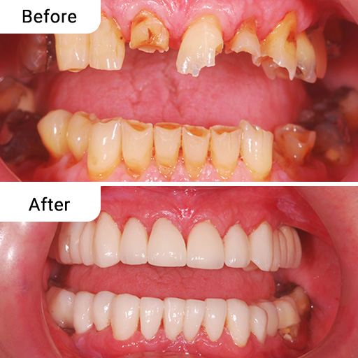 Before and After Dental Treatment