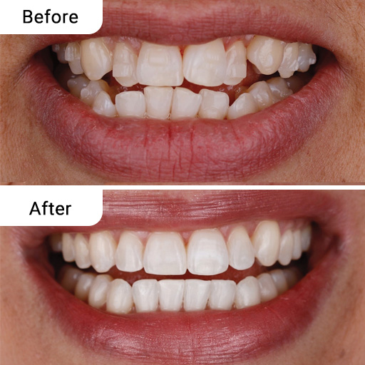 Before and After Dental Treatment