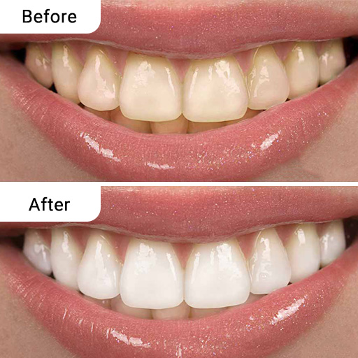 Before and After Dental Treatment