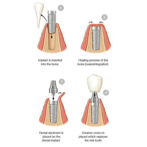 Implant Services in Mulund