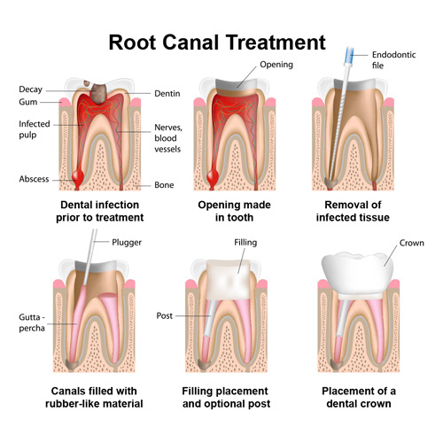 Root Canal Treatment