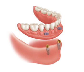 Implant Services in Mulund