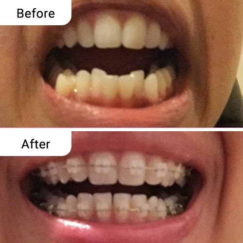 Before and After Dental Treatment