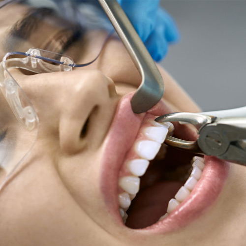 Tooth Extraction