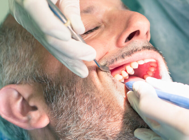 Root Canal Treatment in Mulund