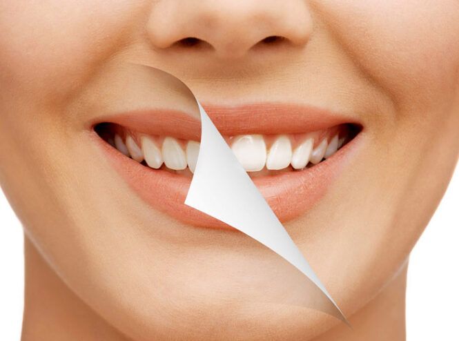 Smile Designing in Mulund - Ivory Dental Clinic